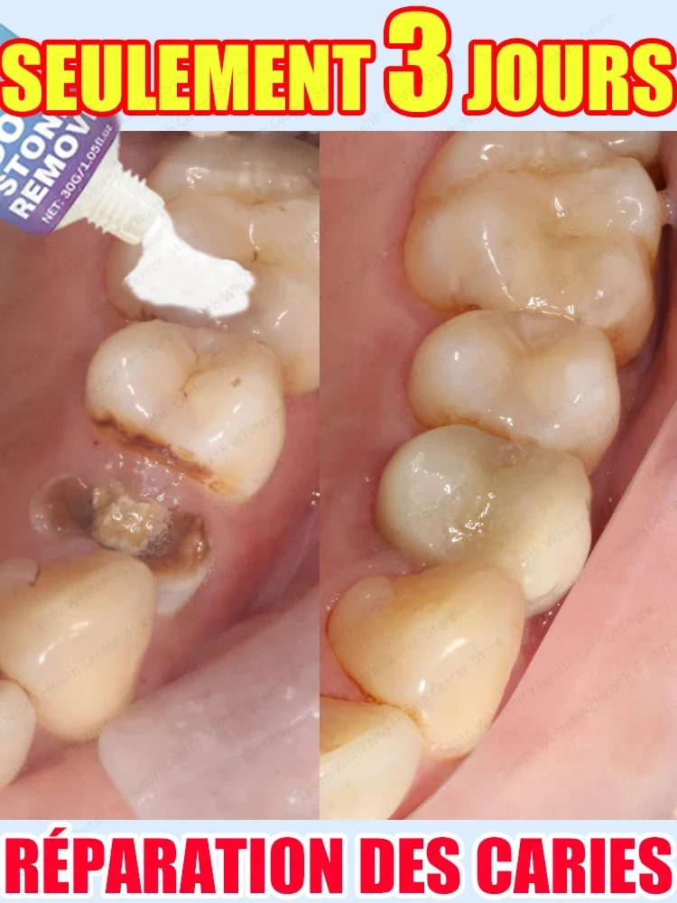 Vendita calda, necessità di molte persone, ripara la carie dei denti e mantiene i denti sani 2026