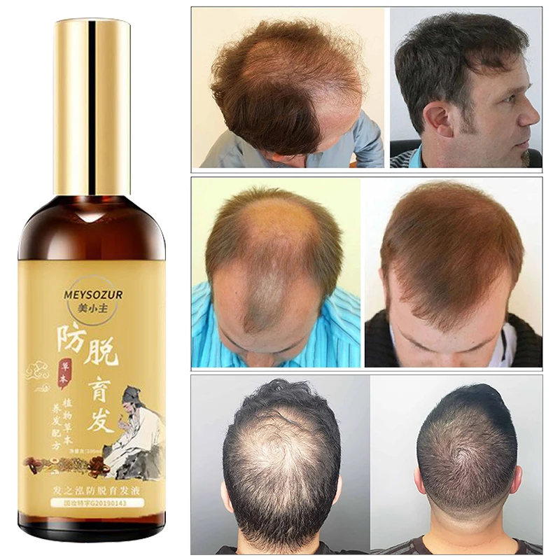 Fast Hair Growth for Men Women Ginger Grow Hair Oil Care Anti Hair Loss Scalp Treatment Serum Products Beauty Health 100ml