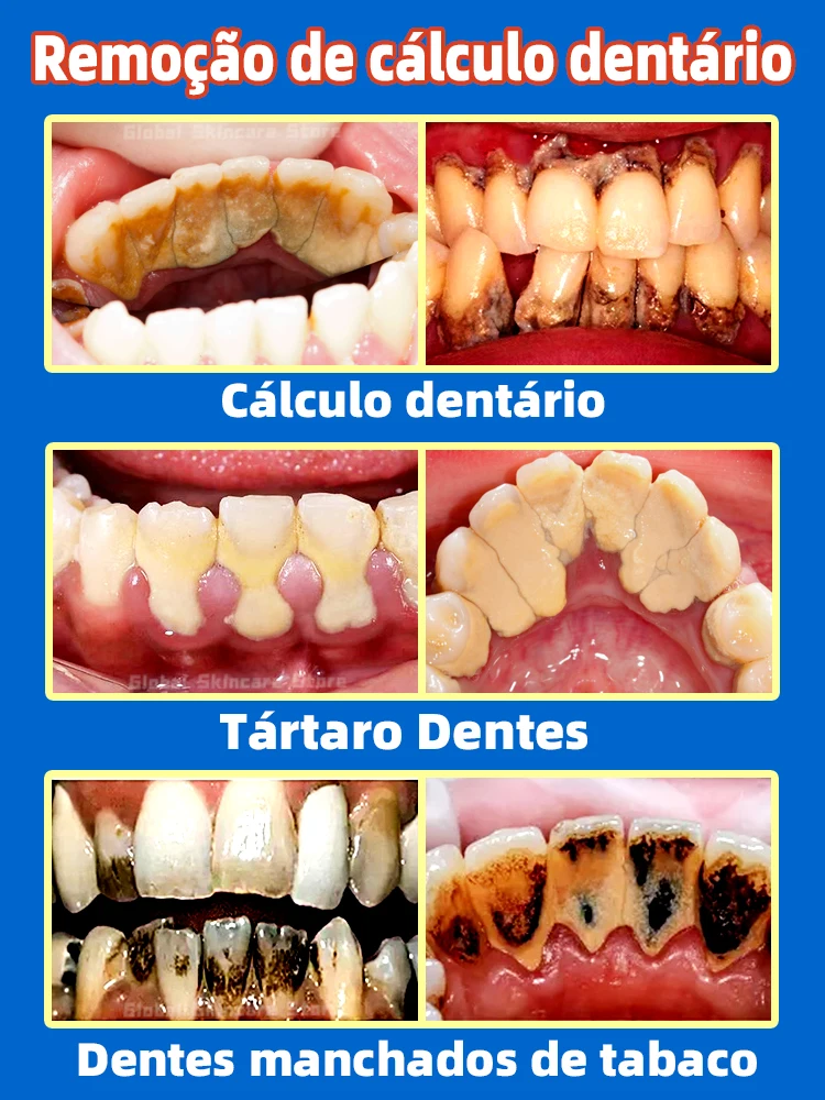 Removedor de cálculo Dental, eliminación de mal aliento, blanqueamiento de dientes, pasta de dientes, brillo, prevención de la Periodontitis,