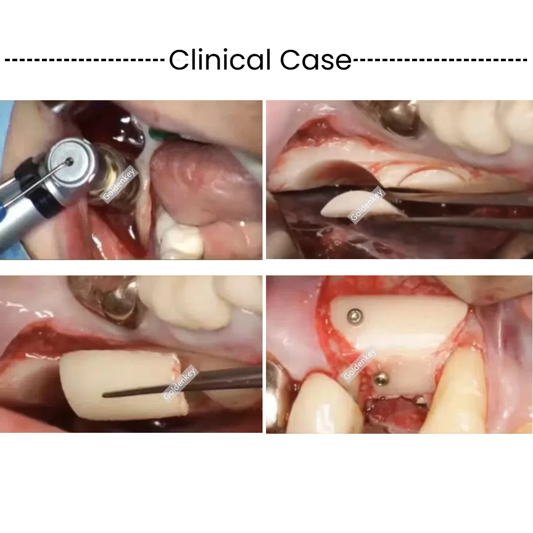 Dental Semilunar Bone Collector Drill GBR SLT Semilunar Technique Semilunar Shell Bone Argumentation Easy Bone Colloector