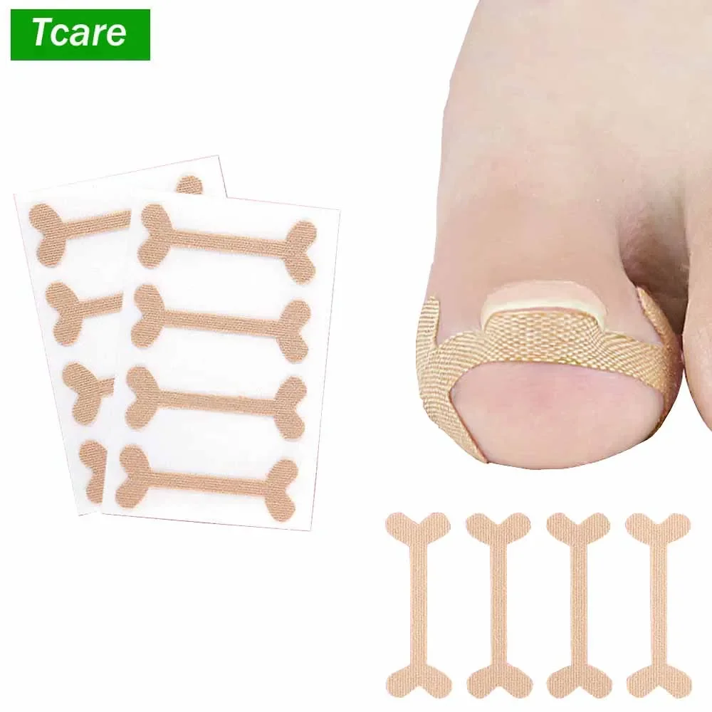 Tcare 1Set Toe Nail Groove Foot Nail Orthodontic Device Thumb Nail Patch Quick Pedicure Toe Nail Deformation Recover Foot Care