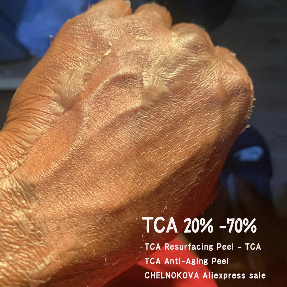 Crema refrescante con solución de neutralización para el cuidado posterior, resultados de la piel de la mano, quelnokova, TCA 20, 30, 35