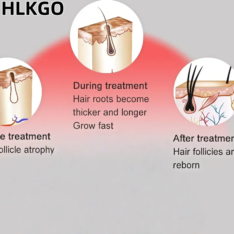 

USB Rechargeable Laser Hair Helmet, 80 Diodes 678nm Wavelength for Hair Regrowth and Loss Treatment Therapy