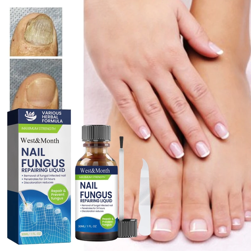 Fungal Nail Treatment Serum Foot Nail Fungus Removal Repair Gel Anti Infection Paronychia Onychomycosis Foot Nails Care Essence
