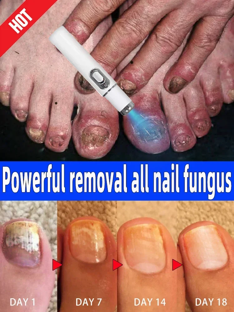 

Laser Product To Solves Nails Troubles