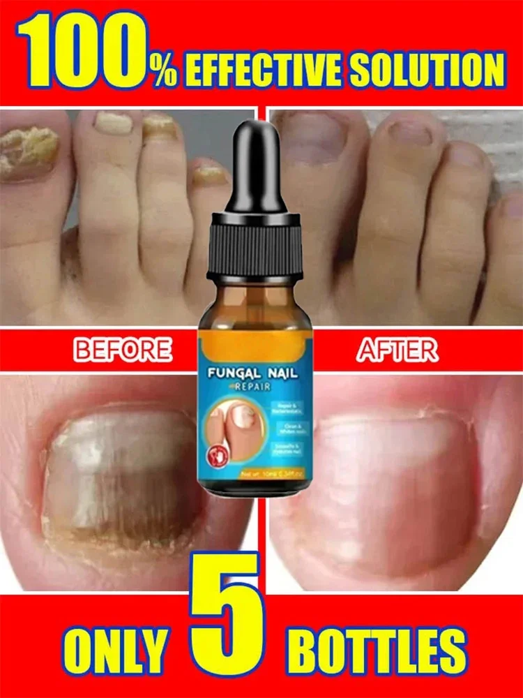 Removal Paronychia Oil Ingrown Toenail Treatment Nail Repair Anti-fungal Soften Removal Fungus Whitening Anti-paronychia Relief