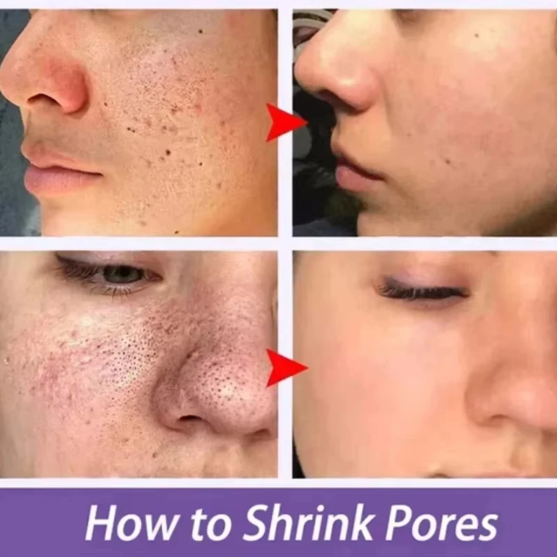 سيروم إزالة المسام الكبيرة، حمض اللاكتيك، منتجات إصلاح تقليص مسام الوجه، تقليل المسام، ثبات العناية بالبشرة الكورية الناعمة.