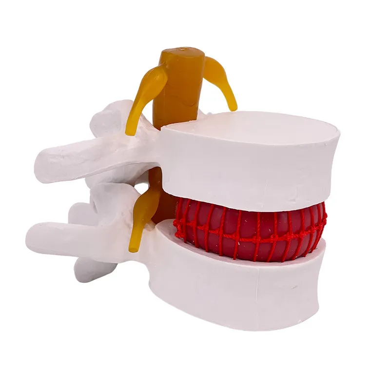Lumbar Expansion, Lumbar Intervertebral Disc Model, Squeeze Herniation Demonstration Model
