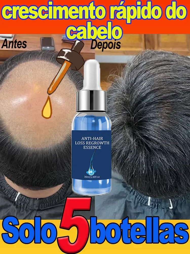 Óleo unissex para crescimento capilar, tratamento para perda de cabelo, rápida e eficaz, reparação de calvície, periódica, pós-parto, perda de cabelo