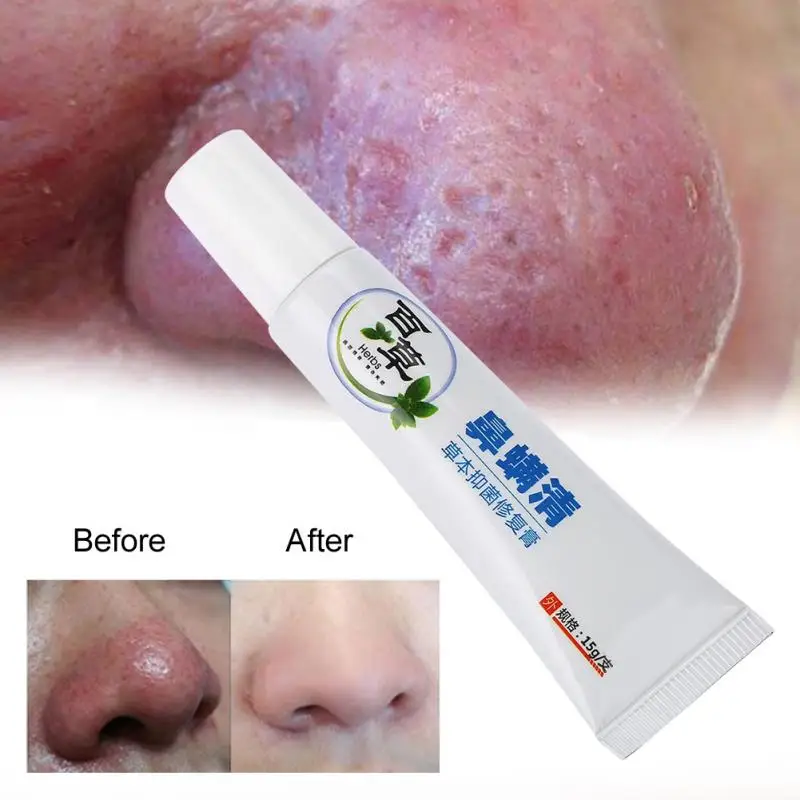 

Rosacea Treatment Cream Nose Redness Removal Cleaning Antibacterial Gel Red Nose Blackhead Remover Skin Care Product