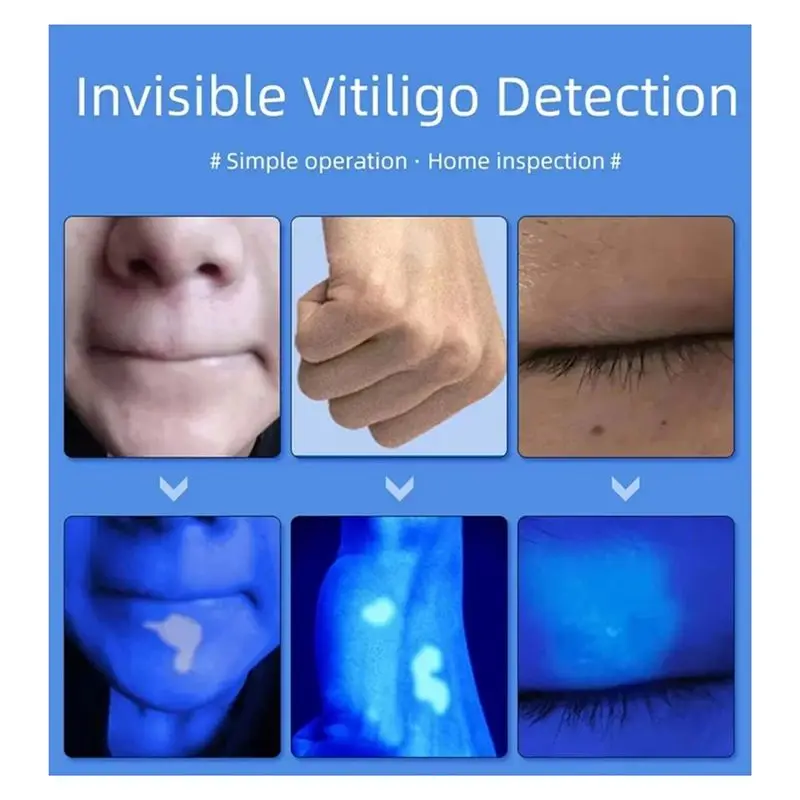 【SURPRISE】Woods Lamp Skin Analyzer Lamp Skin UV Magnifying Skin Analysis Detection Beauty Facial Testing Skin Care EU Plug