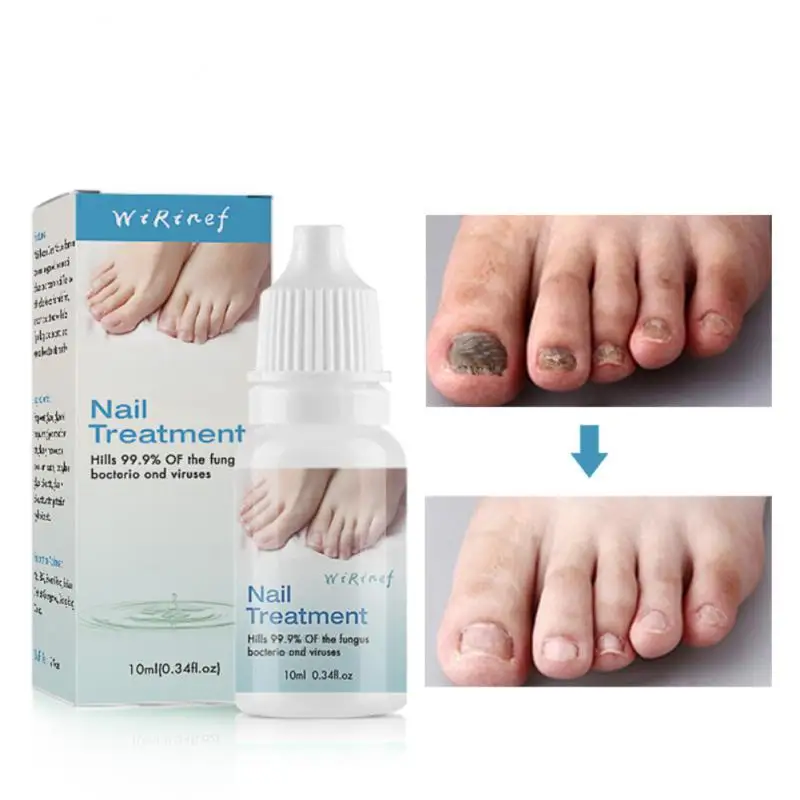 Toe Nail Fungus Remover Fast Acting Revolutionary Nail Fungus For Men Anti Nail Fungus Cure Popular Powerful