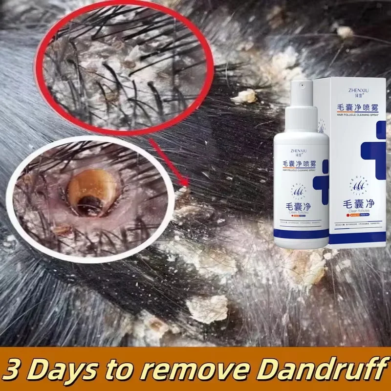 New 30ml Hair Scalp Treatment Spray Remove Dandruff Itching Oil Control Anti Loss Scalp Cleaning Repair Serum Beauty Hair Care
