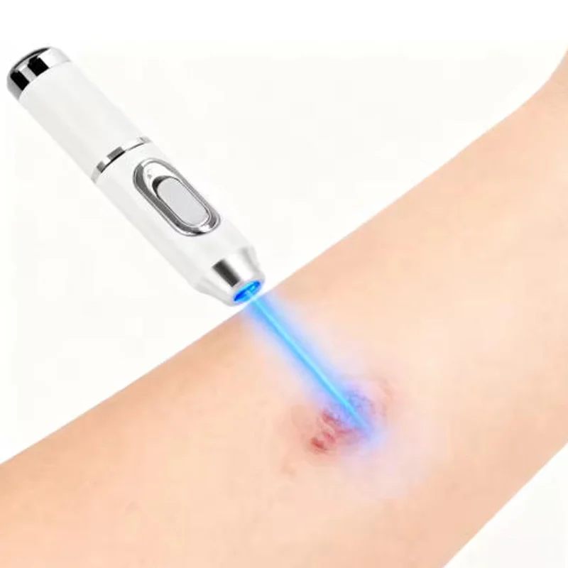 

Удаление бородавок с лазерной ручкой, безболезненное удаление бородавок и предотвращение повреждений