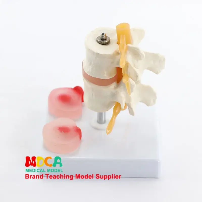 Medical Teaching Of Human Skeletal Spinal Model With Two Lumbar Vertebral Lesions And Intervertebral Discs MYZ001