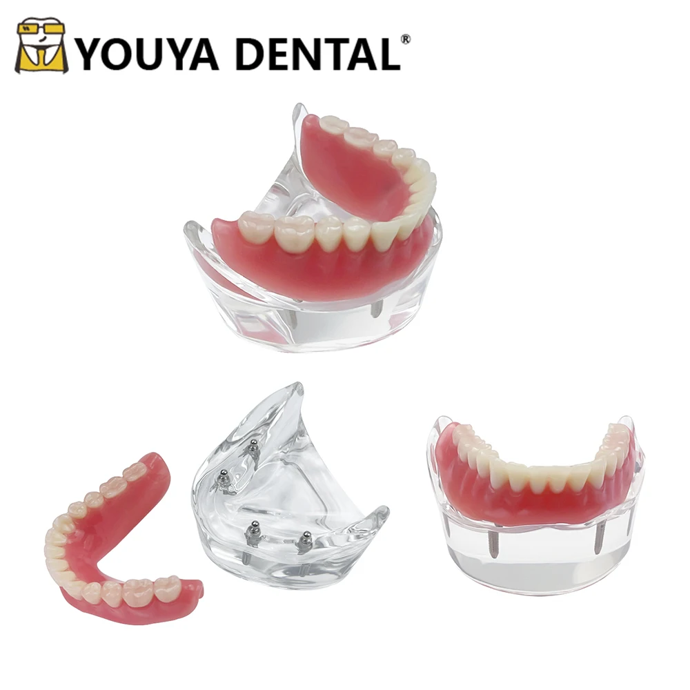 Removable Lower Jaw Implant Practice Model Dental Overdenture Teeth Model for Dental Technician Studying Teaching