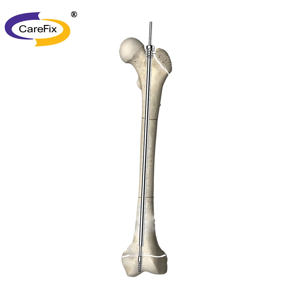 Ortho*pedic Femoral Intramedullary Tibia Proximal Femur Interlocking Nail