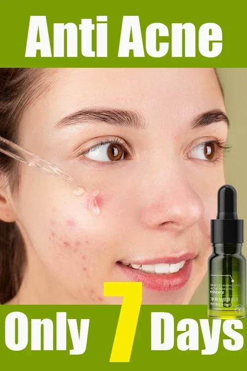 

Acne Remover Face Serum Herbs Acne Treatment Pimple Remover Shrink Pores Oil Control Face Herb Acne Skin Care