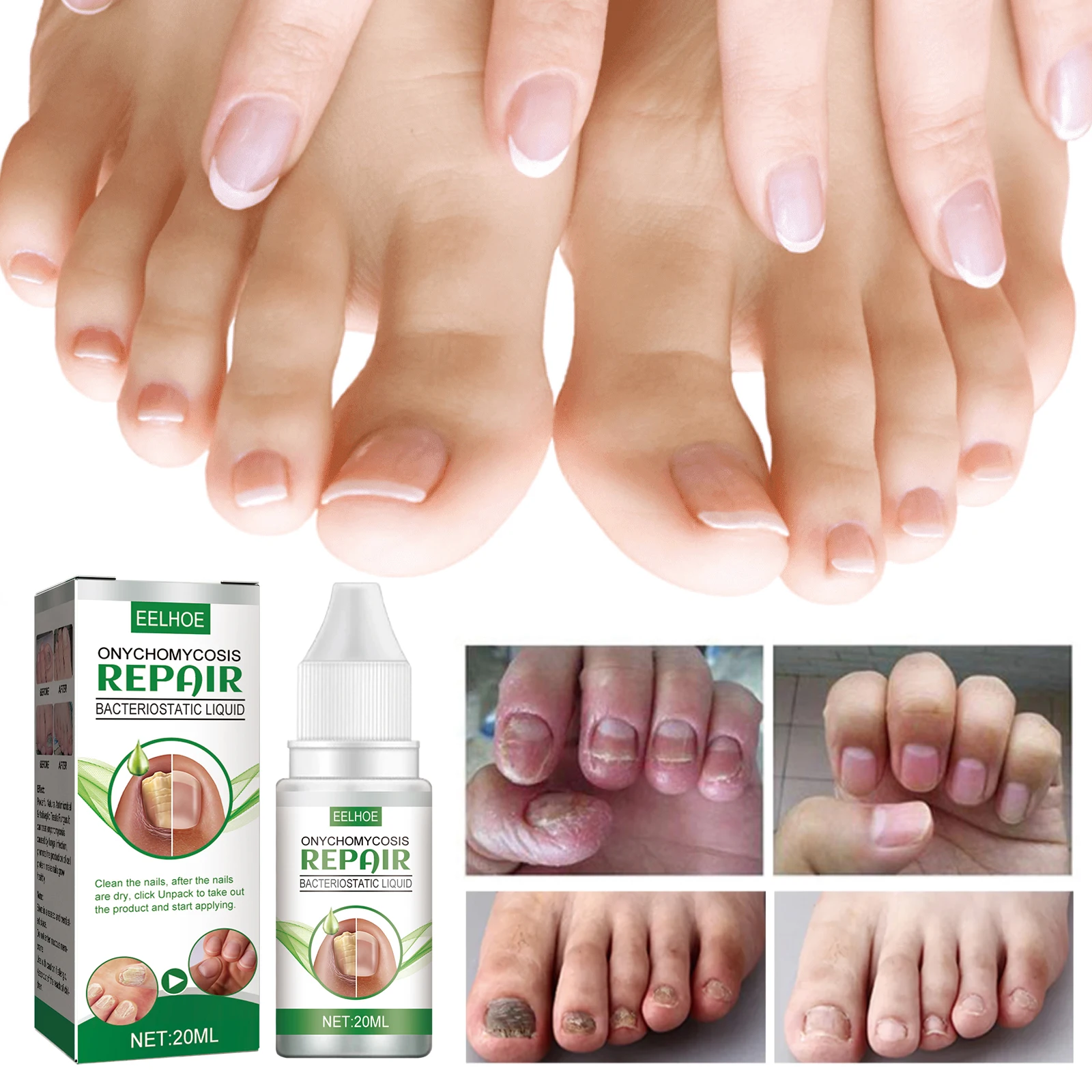 Fungal Nail Treatment Oil Foot Repair Essence Toe Nail Fungus Removal Gel Anti Infection Cream Fungal Nail Removal