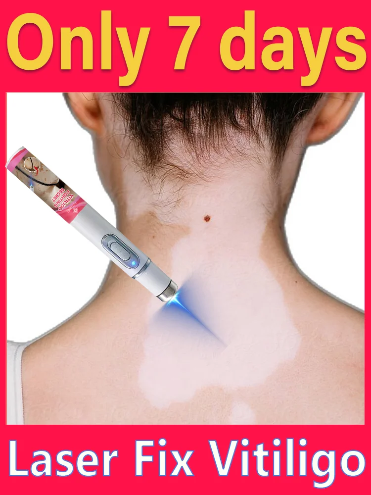 Generation-2 Laser Says Goodbye To Vitiligo In 7 Days