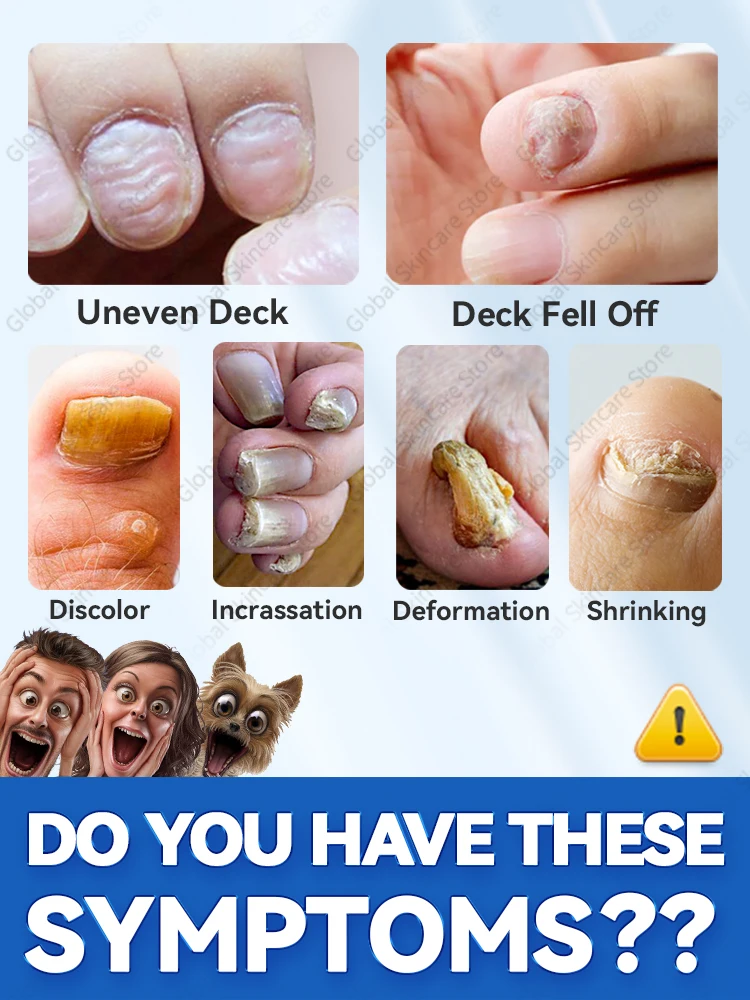 Foot Nail troubles Solved completely