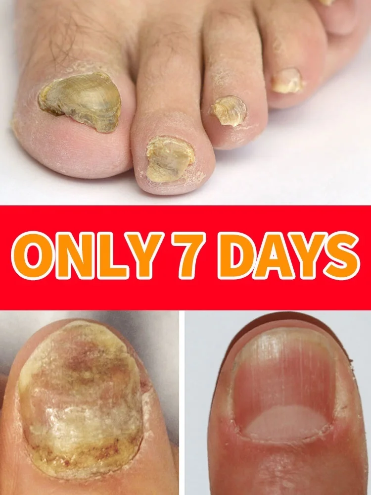 

Blue light device Applicable to Onychomycosis