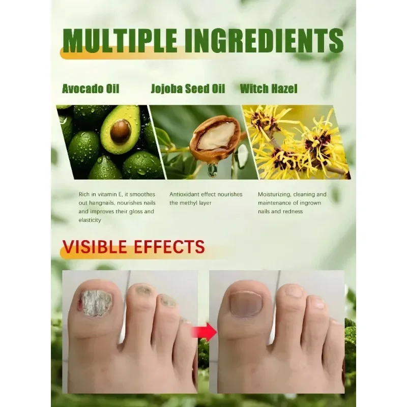Ätherisches Öl zur Nagelspilzbehandlung, repariert Onychomykose in 7-Tage