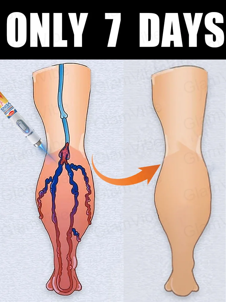 

blue light pen solve varicose veins, hot sale leg care tools
