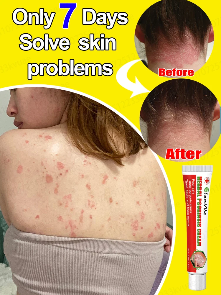 

Healthy skin, happy self ᴏᴠᴇʀᴄᴏᴍᴇ ɪᴛᴄʜɪɴɢ, ᴄᴏᴍғᴏʀᴛᴀʙʟᴇ ᴇᴠᴇʀʏ ᴅᴀʏ