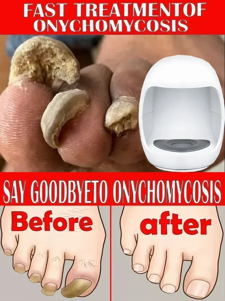 Fungal Nail Laser Onychomycosis Fungus Nails Repair Fast