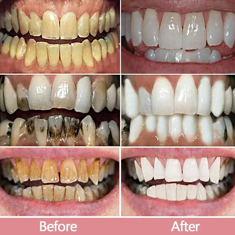 Fast Remove Smoke Stains Toothpaste Teeth Whitening Strips Remove Plaque Stains Oral Hygiene Cleaning Fresh Breath Dental Tools