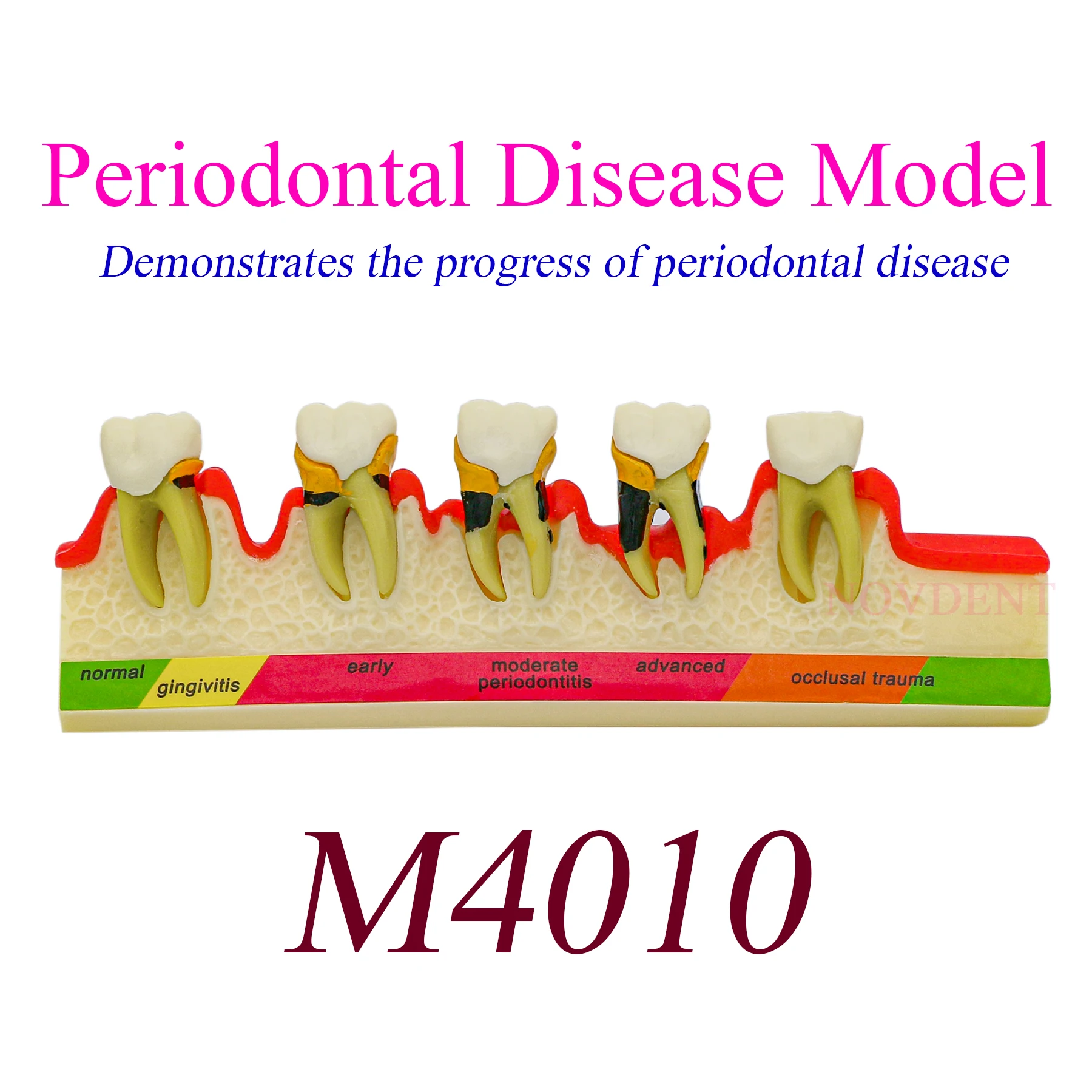 Dental Periodontal Disease Classification Model 5 Stages Dentistry Education Tooth Model M4010 Caries Teeth Model Dentist Clinic