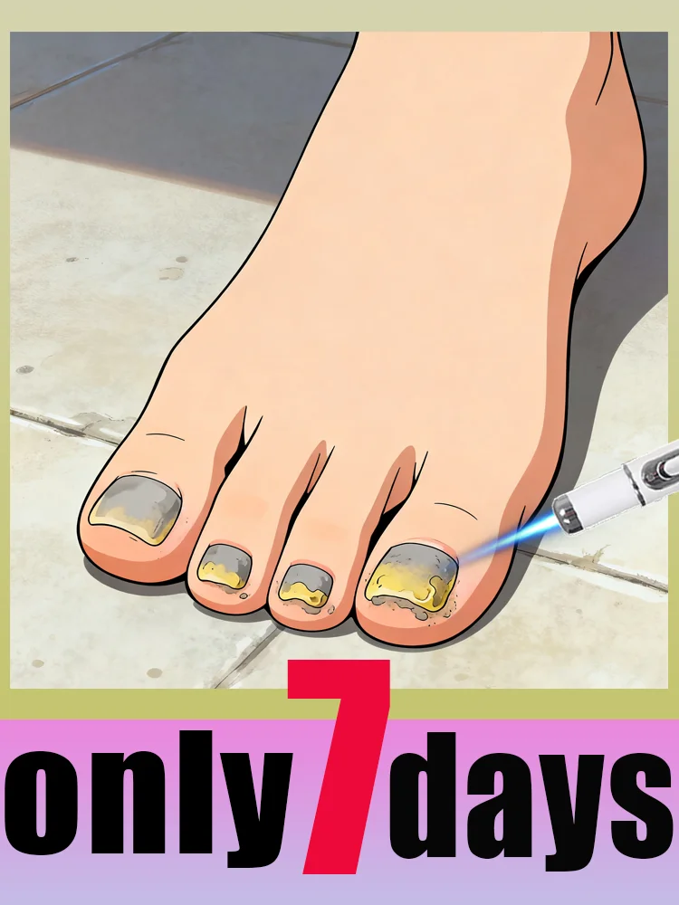 

Синяя лазерная ручка 2025 года Anti-FungalSay Добро пожаловать в онихомикозе, безопасная и эффективная