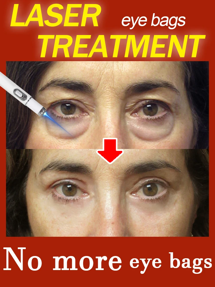 Laser Pen for Dark Circle and Eye Bag Removal