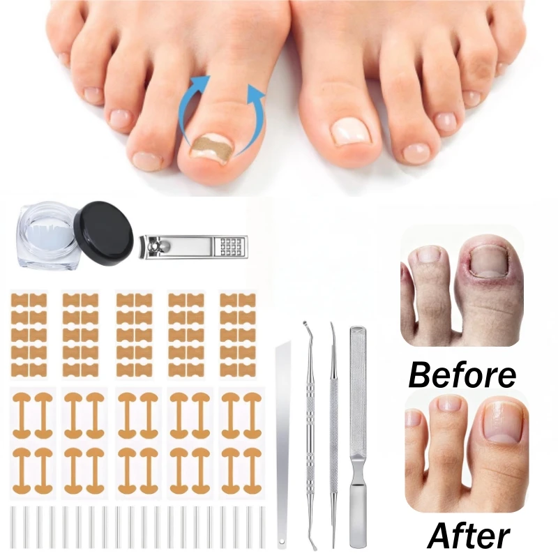

Ingrown Toenail Corrector Toenail Straightener Orthosis Stretching Patches Nail Repair Tools Pedicure Manicure Kit