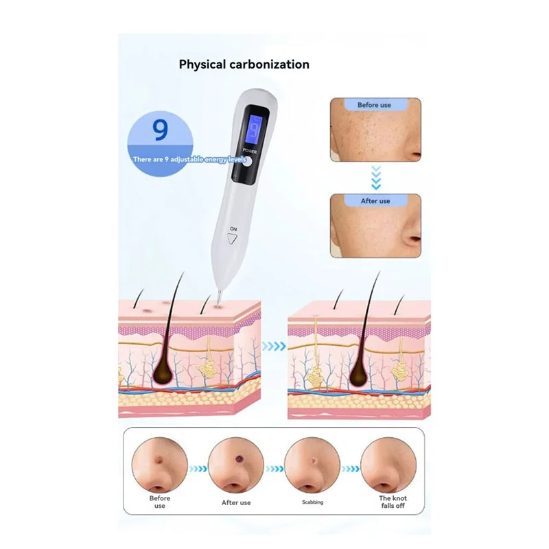 

Painless Safe Skin Tag Mole Wart Spot Removal Equipment For Smooth Skin Wart Remover Eyelid Lifting Acne Treatment Pen-A54Q