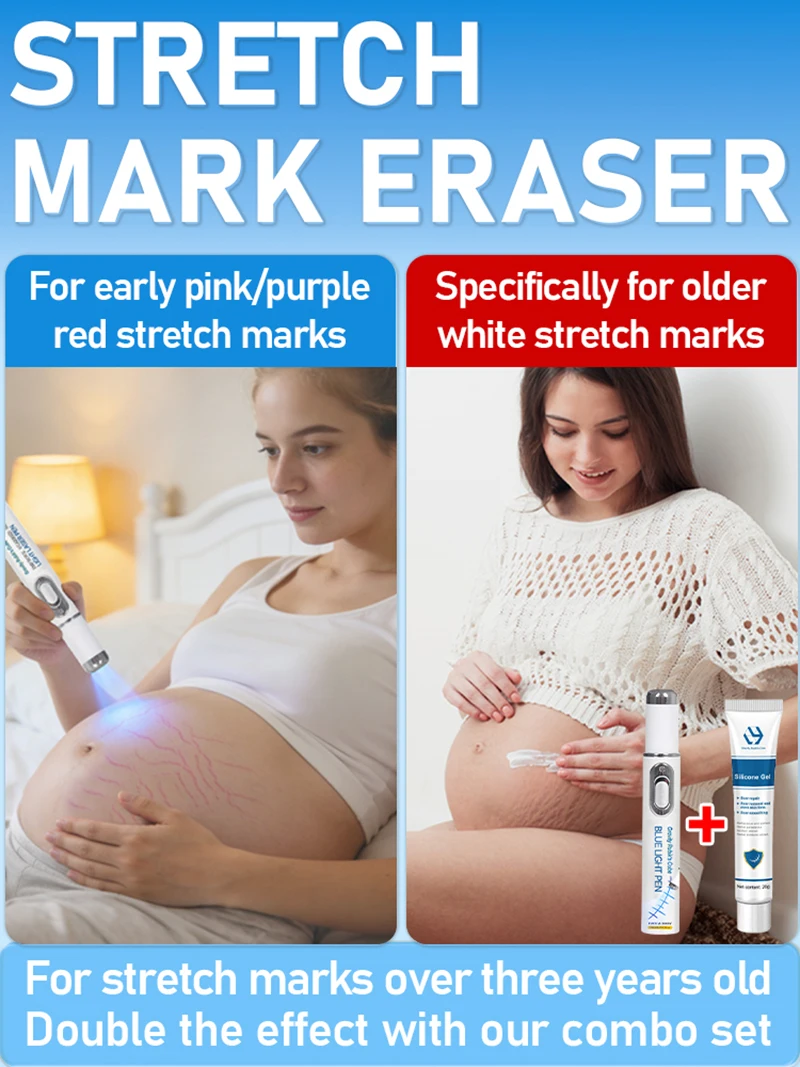 Striae Blue Light-apparaat Elimineert lichaamsstriae Producten Gereedschappen