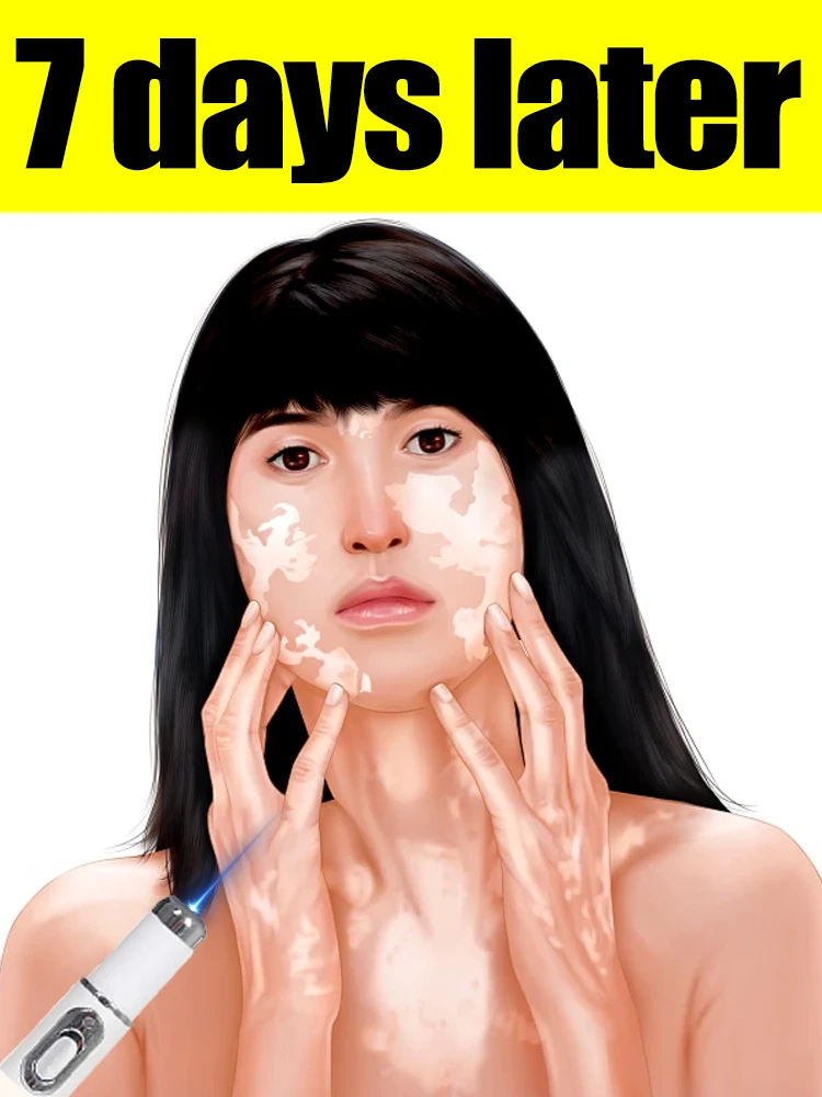 Generation-TWOND Laser Says Goodbye To Vitiligo In 7 Days