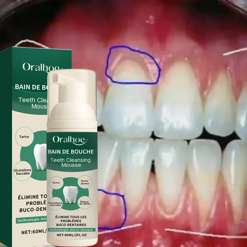 Rapid Repair Gums Mousse Effectively Relieve Tooth Allergy Dental Caries Tooth Cleaning Toothpaste Relieve Tooth Damage Drops