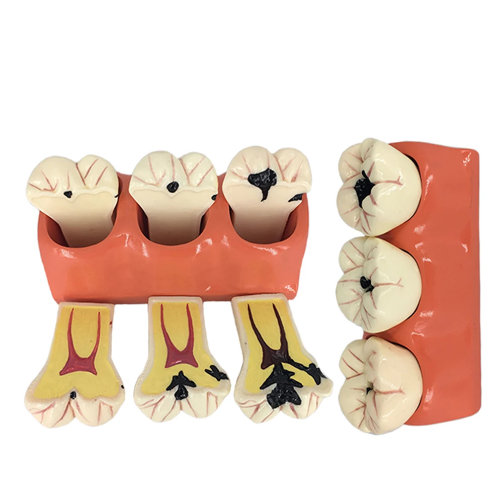 4Times Caries Comparation Models Caries Decomposition Dissected teeth model Teaching research Study model for dentistry students