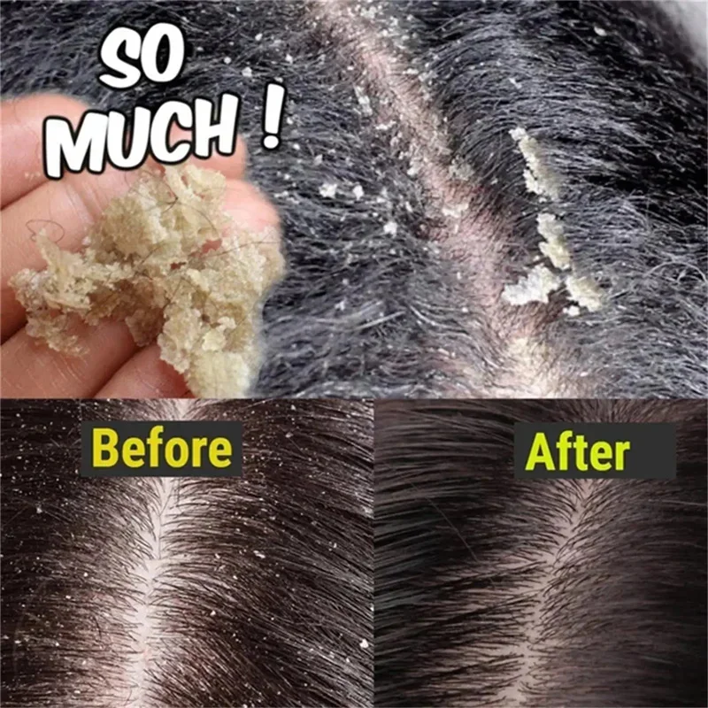 

Fast Anti Dandruff Hair Treatment Soap Itching Repair Scalp Cleaning Exfoliating Products Oil Control Antipruritic Hair Care