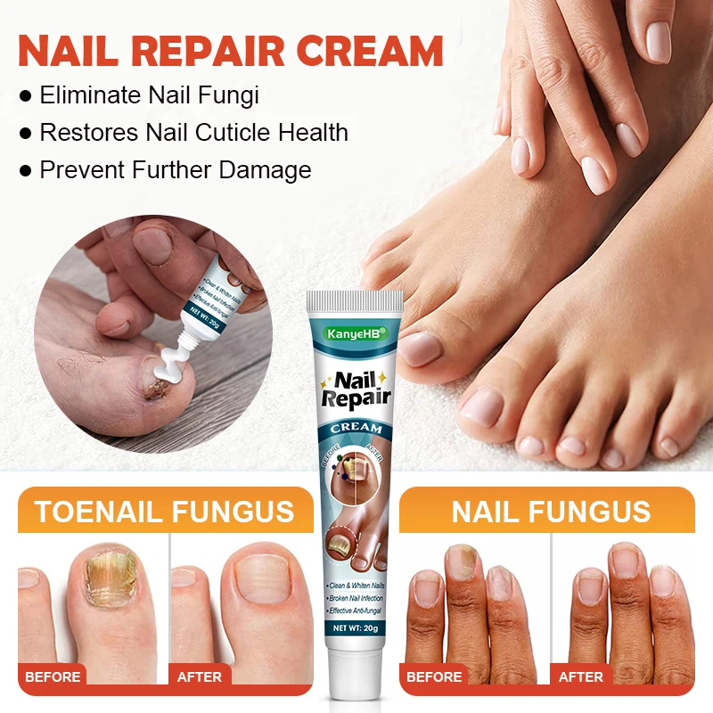 1pcs Nail Antibacterial Cream Nail Fall Off Nail Discoloration Onychomycosis Treatment Cream Toes Nail Fungus Removal Cream G048