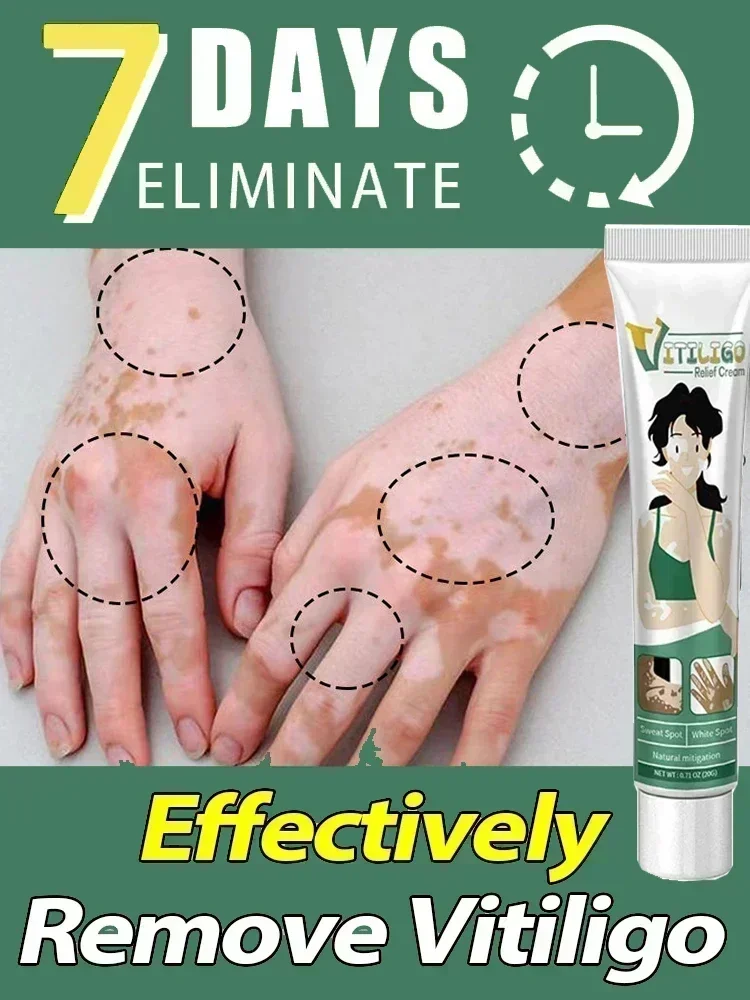 

Improve Skin Pigmentation and Reduce White Spots Vitiligo Treatment 0903