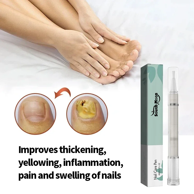 5 Pcs Nail Treatment Pen Anti Fungal Nail Ingrown Correction Anti Fungus Infection Cleaner Toenail Care Paronychia Repair Tools