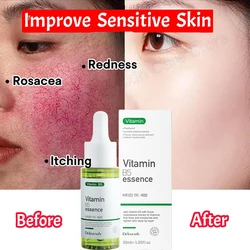 Facial Redness Repair Serum Improve Sensitive Skin Dryness Moisturizer Hydrating Sooth Lotion Removal Rosacea Korean Cosmetics