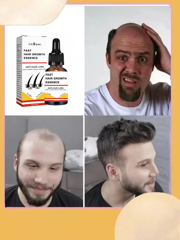 Você precisa de um penteado!! O cabelo fica mais e mais, diga adeus à calvície, cabelo torna-se mais grosso, produtos mais vendidos.