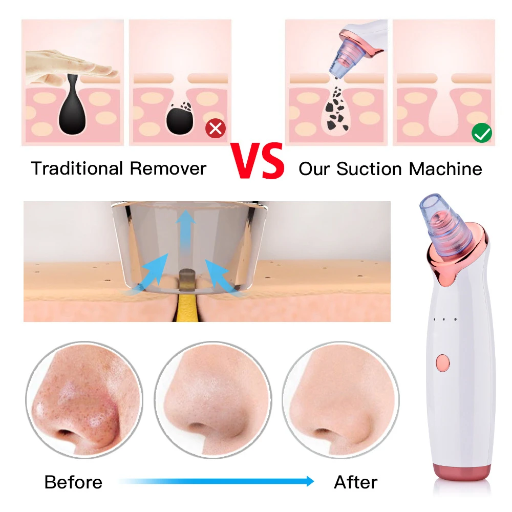 Dispositivo professionale per la rimozione dei punti neri elettrico a bolle ultrafini, aspirapolvere viso, estrazione dell'acne e dei pori, pulizia del viso, pe