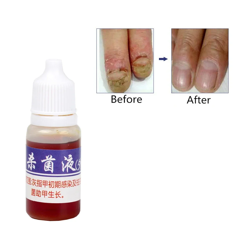 Anti Infection Fungal Nail Treatment Liquid Foot Care Essence Whitening Toe Nail Fungus Removal Gel Paronychia Onychomycosis