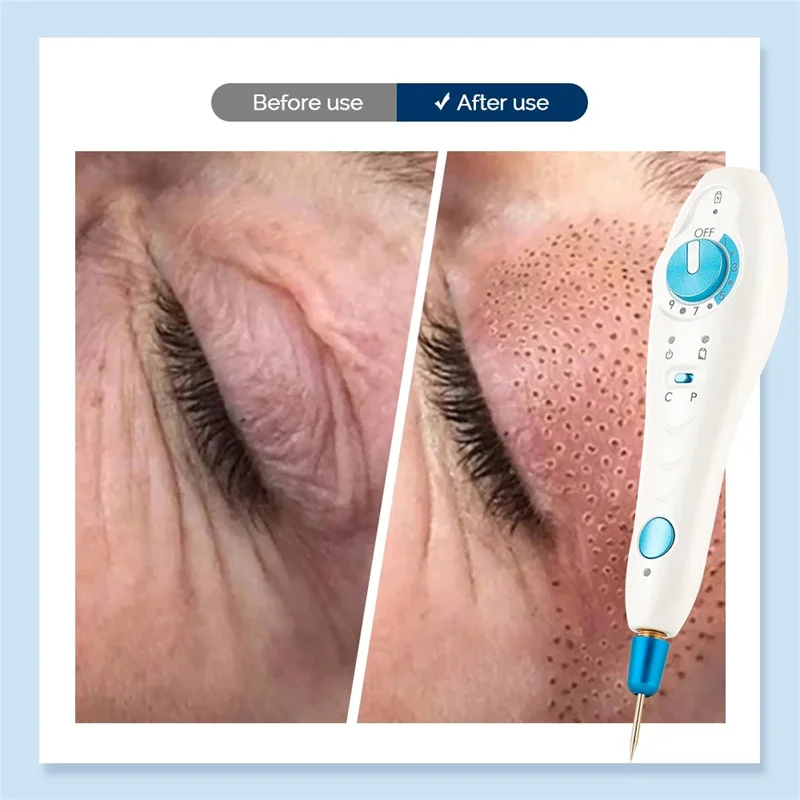 Lápiz de Plasma Fibroblast Portátil para Lifting de Párpados, Eliminación de Arrugas, Reafirmación de la Piel, Eliminación de Pecas y Manchas Oscuras, Máquina de Belleza con Tecnología Maglev