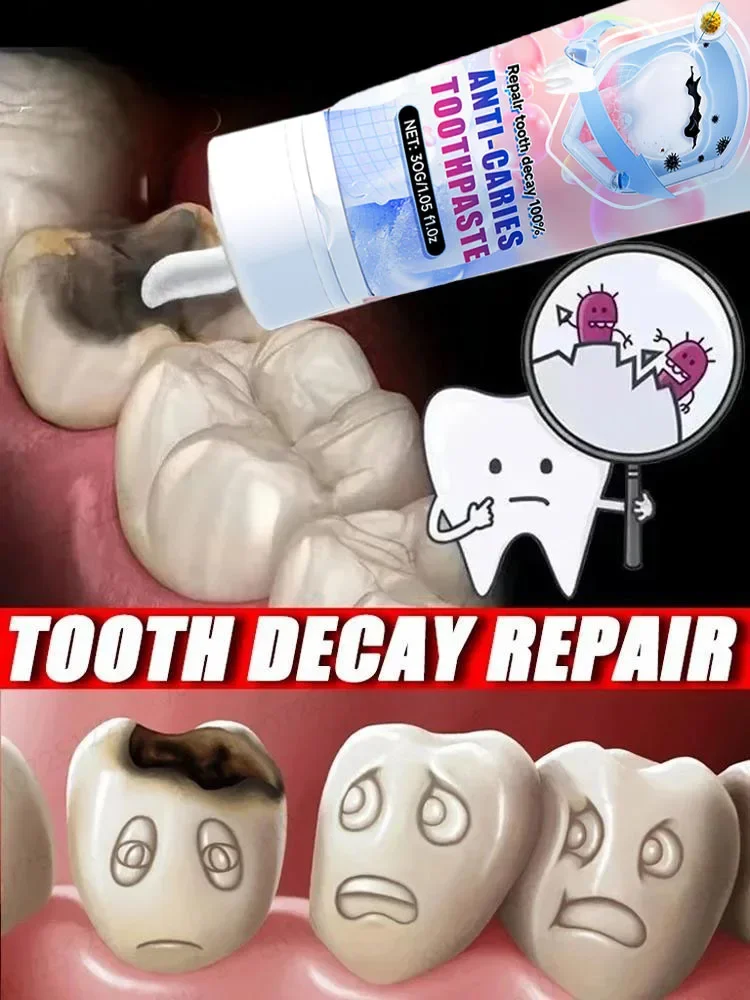 معجون أسنان مضاد للتجويف، إعادة تعيد الأسنان، إصلاح المينا، تعزيز، حماية التسوس، أسنان الأسنان #1